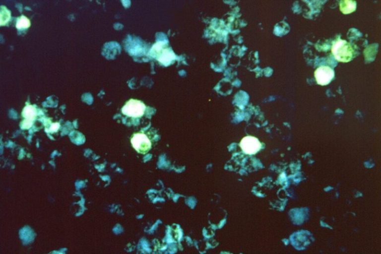 Epstein-Barr virus may be leading cause of multiple sclerosis